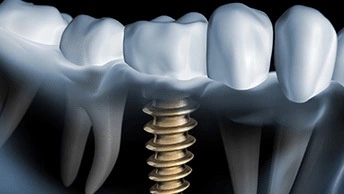 The Average Prices For A Single Tooth & Full Mouth Implants
